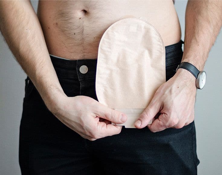 Balneário Camboriú: Projeto de Lei quer instituir programa de apoio a pessoas ostomizadas