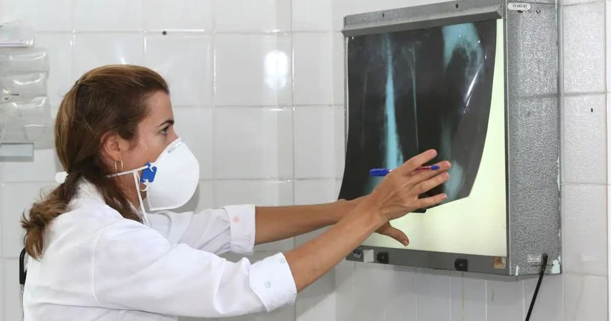 Saiba quantos casos de tuberculose foram registrados em Brusque em 2026 - O Município