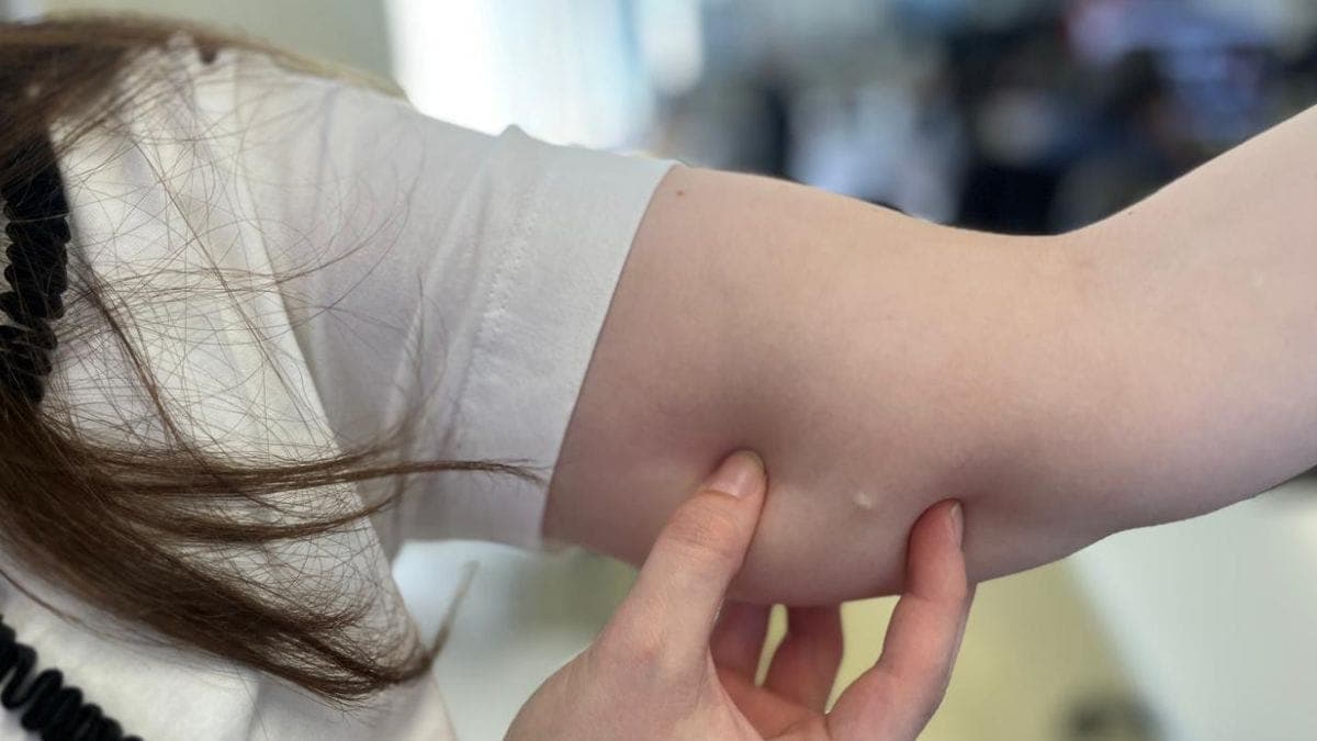 Implanon: distribuição de novo método contraceptivo chega a pequenas cidades de SC